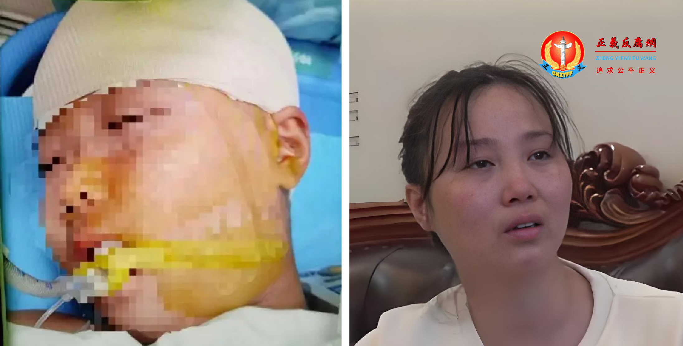 湖南省长沙市一名9岁女孩被老师用三角尺砸伤头骨，伤情构成重伤二级。此案经一审、二审，被告人最终被判刑五年。图为长沙被打伤的女孩（左）及其母亲。.png