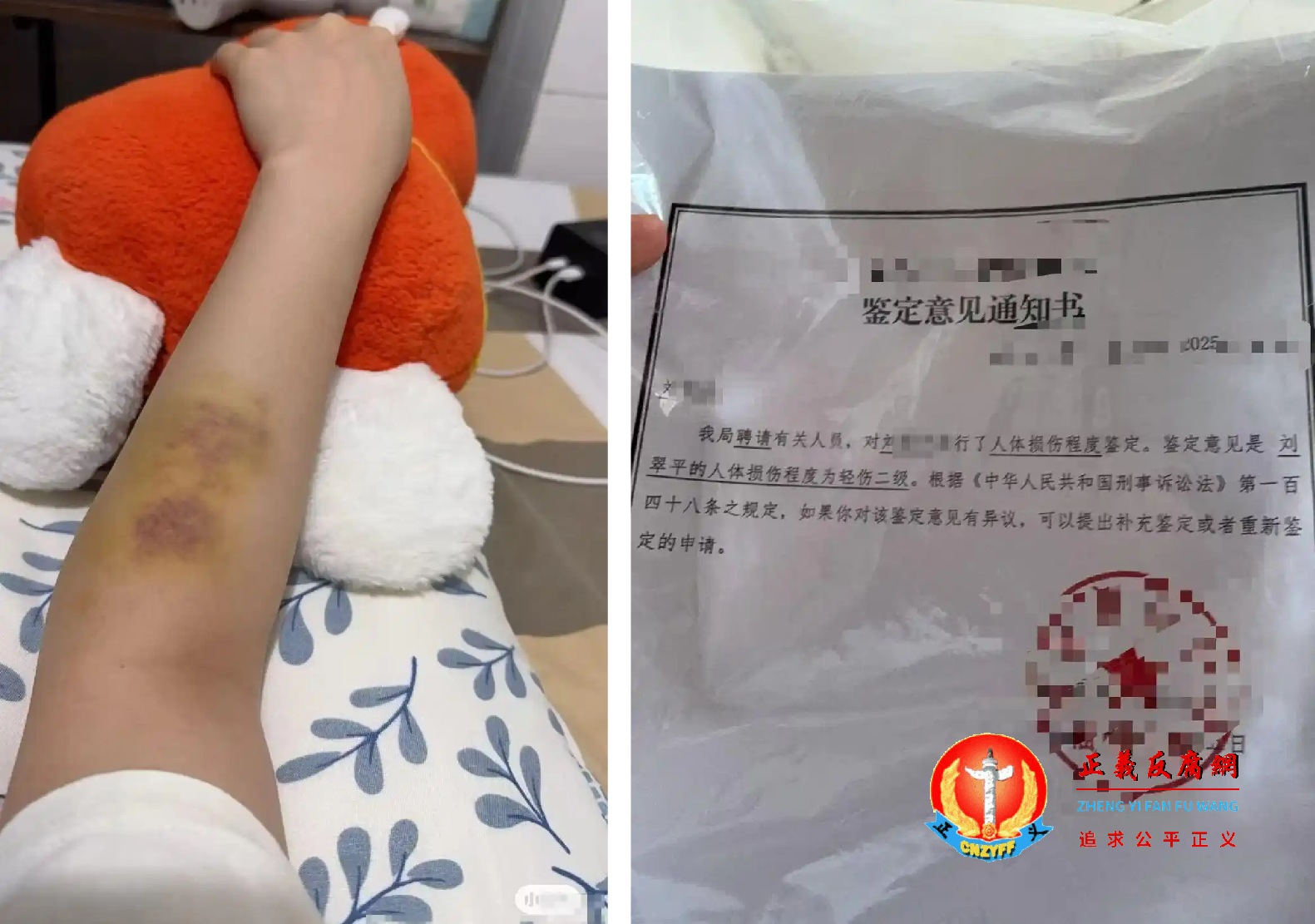 李女士胳膊被戳致淤青（左图）。面试被殴打的刘女士构成轻伤二级（右图）。.png